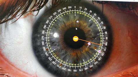 איריס גייר - אירידולוגיה אבחון בגלגל העין